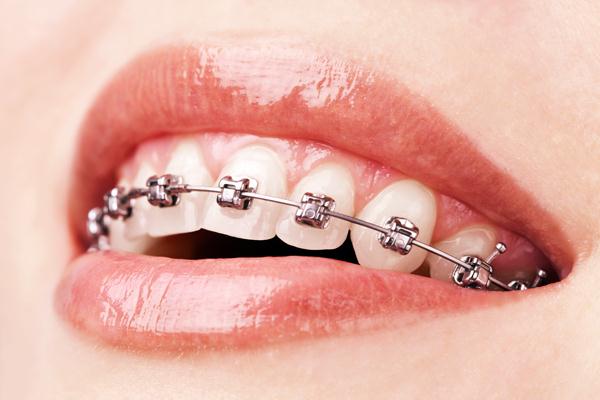 ortodonti-tel-tedavisi