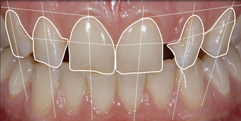 gülüş-tasasrımı-dentalis